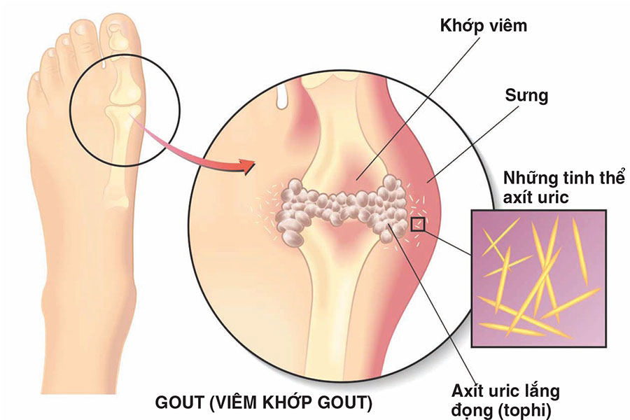 nguyen-nhan-gay-ra-benh-gout-la-do-khop
