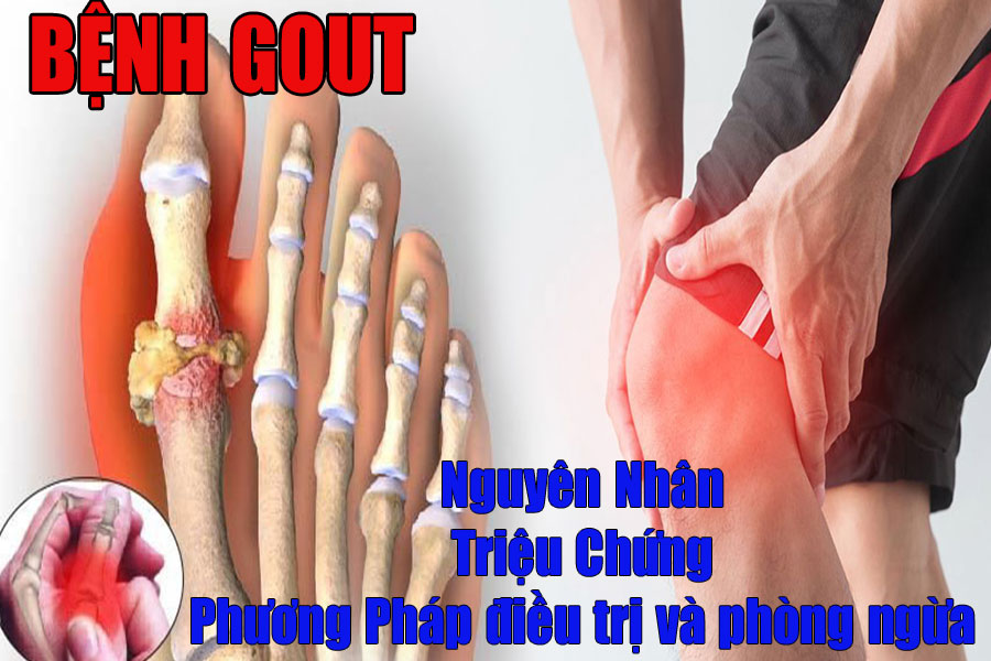 nguyen-nhan-va-cach-dieu-tri-benh-gout-mot-cach-nhanh-nhat